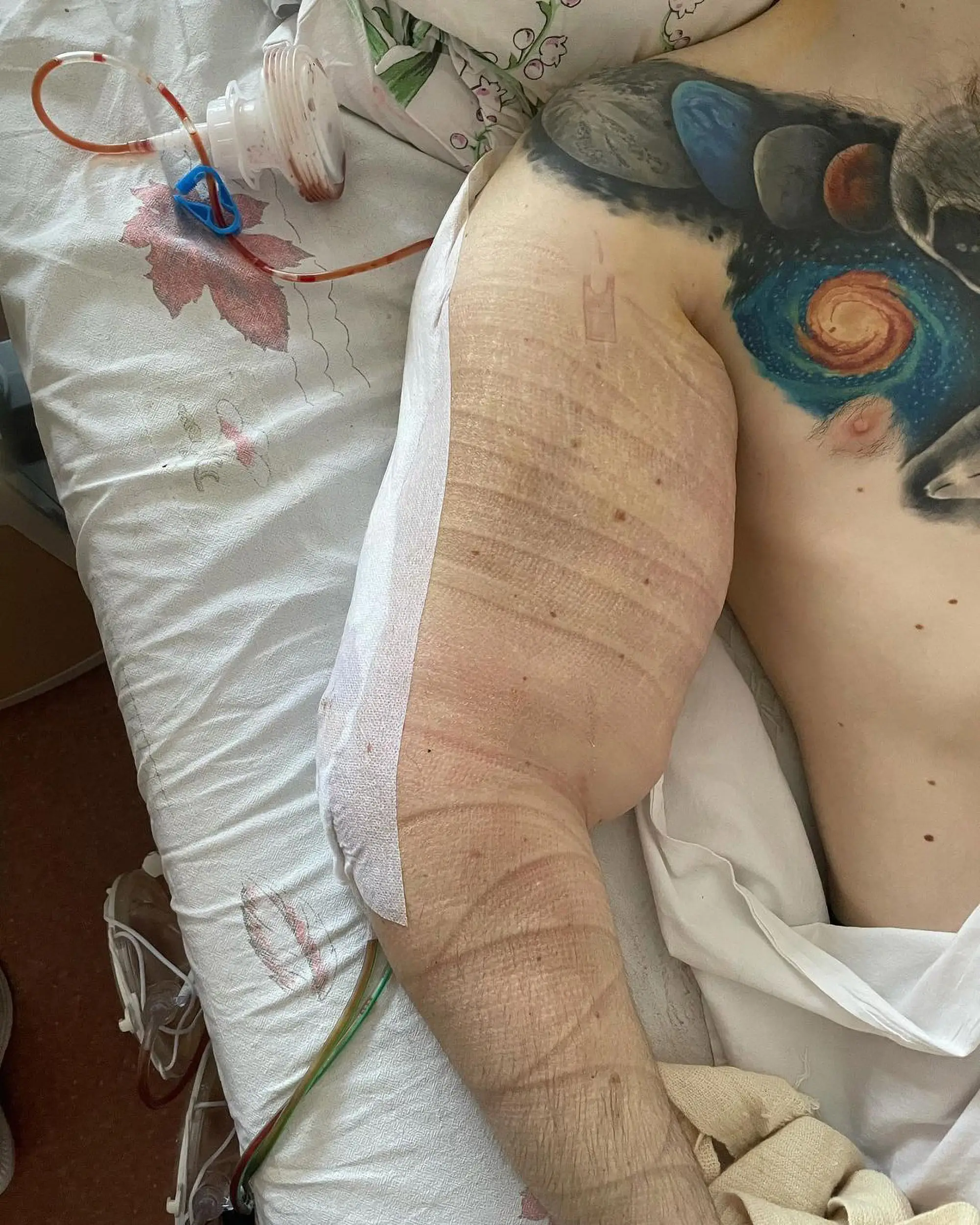 Doctors have reportedly warned him that a severe infection means they might need to amputate his arms (@‌ruki_bazuki_official/NewsX)