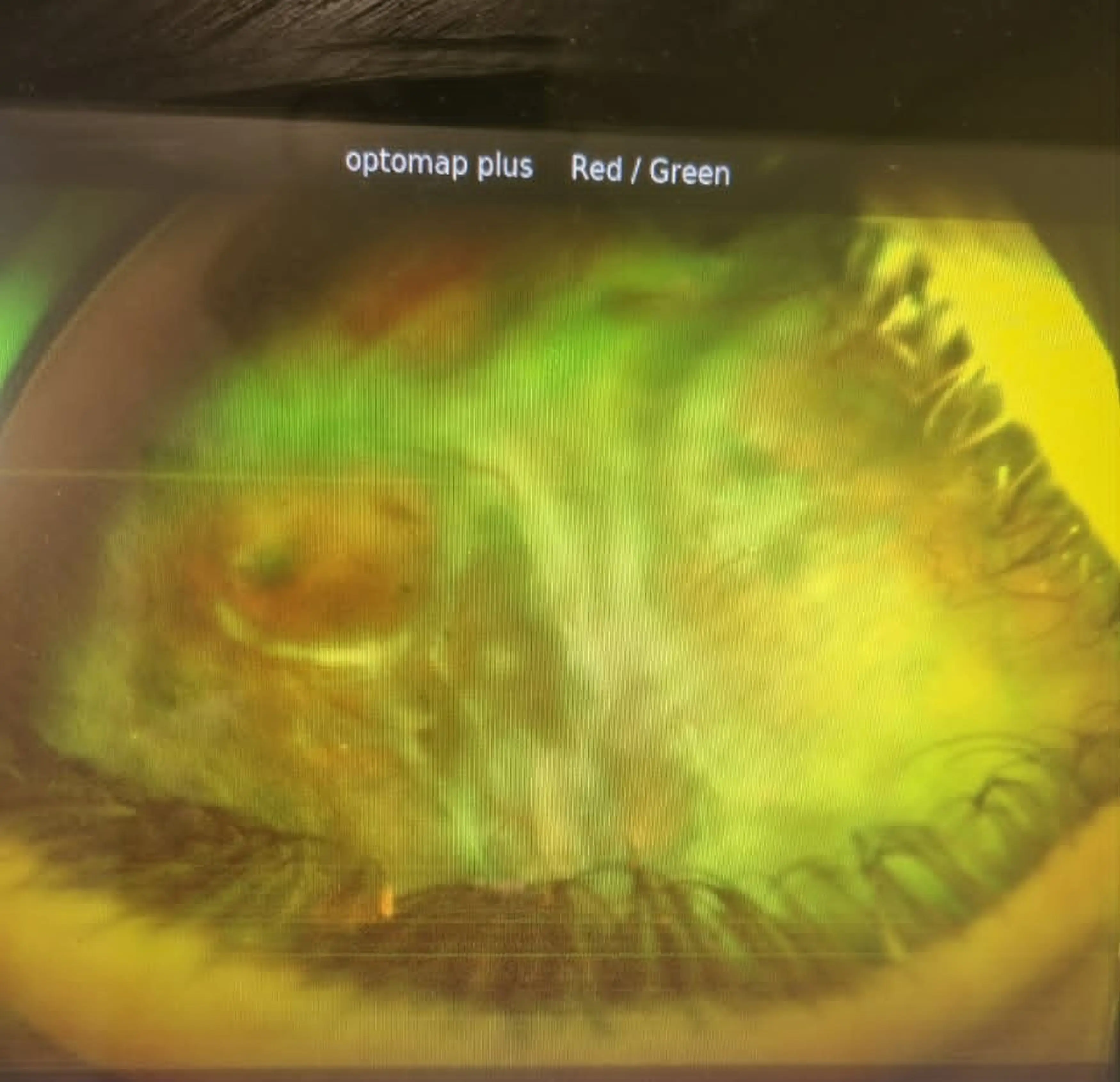 Told she had a non-cancerous tumour, Jade went through lots of treatment before being told her eye would have to be removed (Kennedy News and Media)