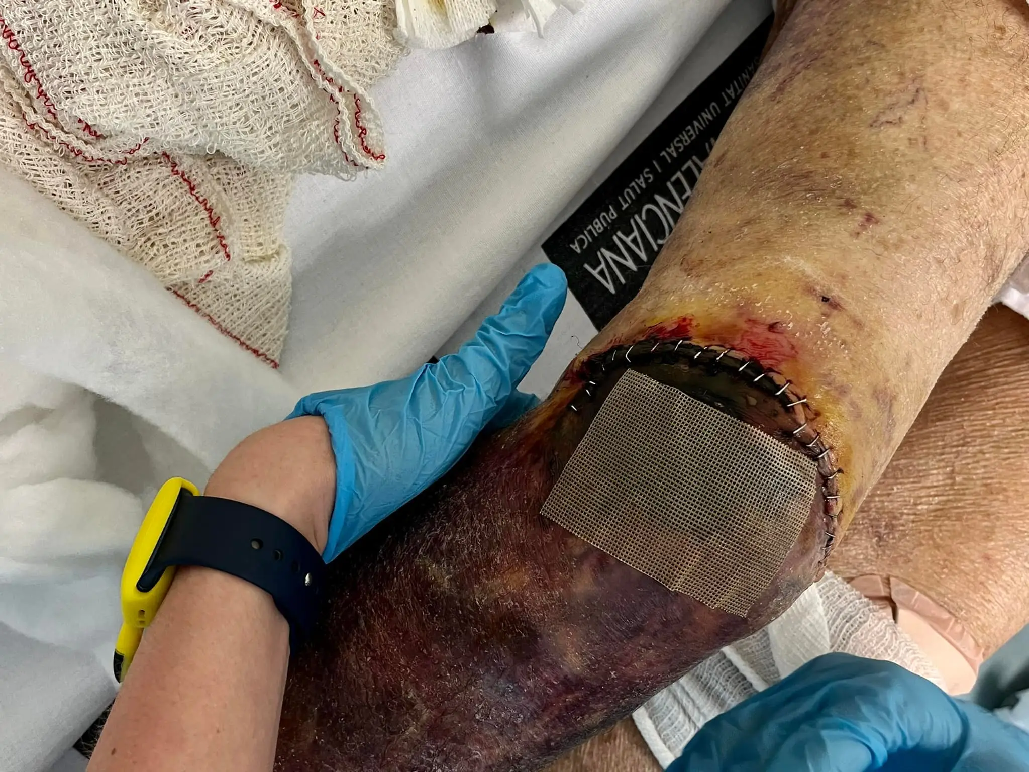 She has been in and out of hospital since the fall.