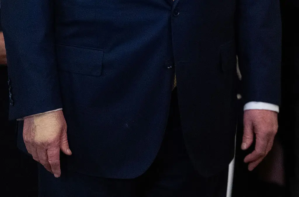 He has also been spotted with bruises and discolouration on his right hand (ANDREW CABALLERO-REYNOLDS / AFP)