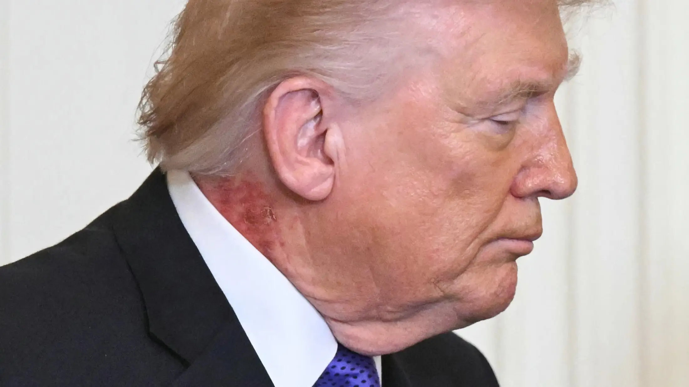 Donald Trump has sparked speculation after appearing in public with a rash on his neck (SAUL LOEB / AFP via Getty Images)