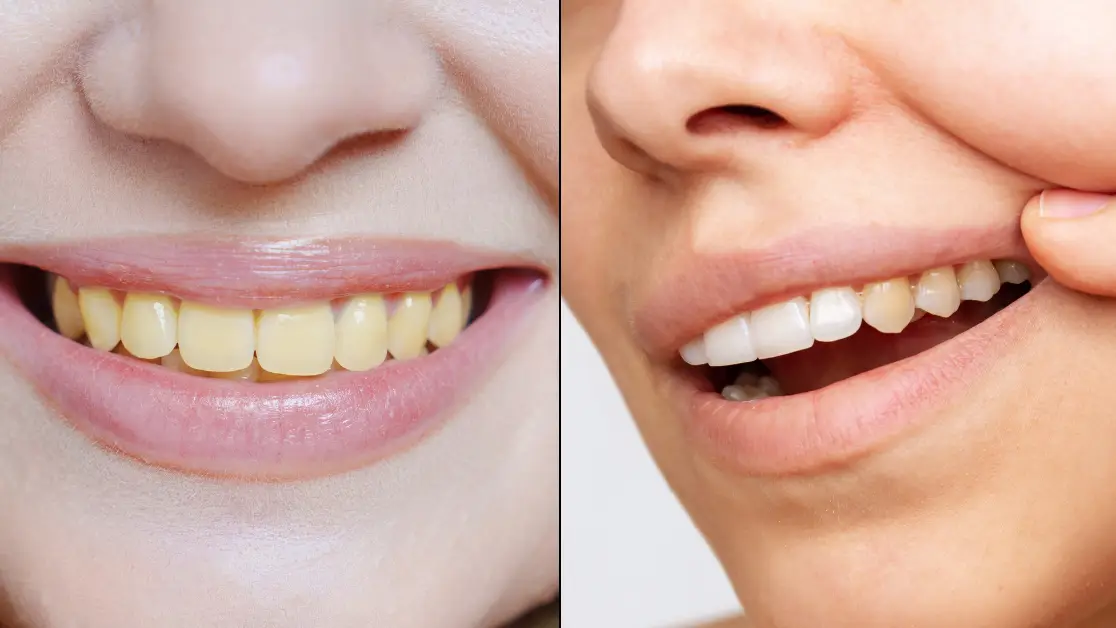 Dentist reveals common Christmas mistake people make that causes their teeth to turn yellow