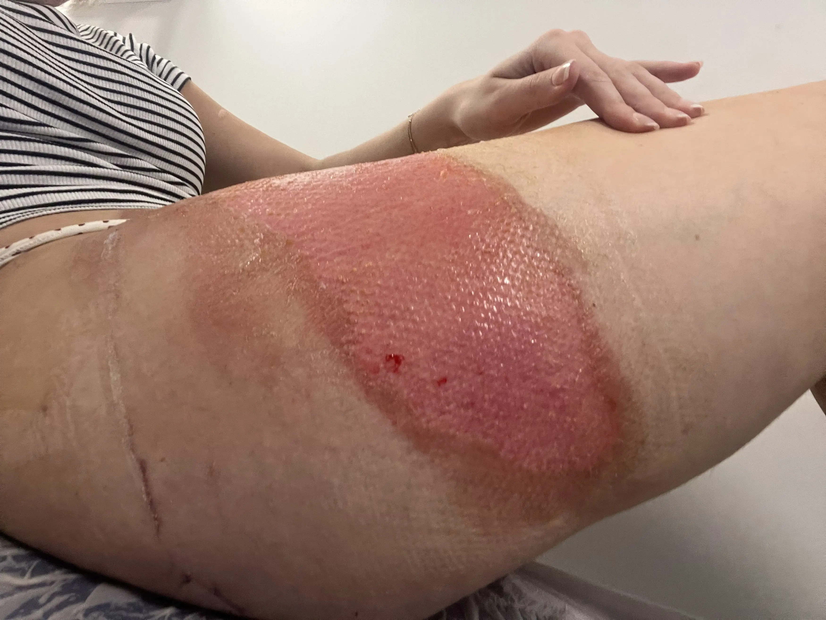 Annie suffered horrendous burns (Kennedy News and Media)