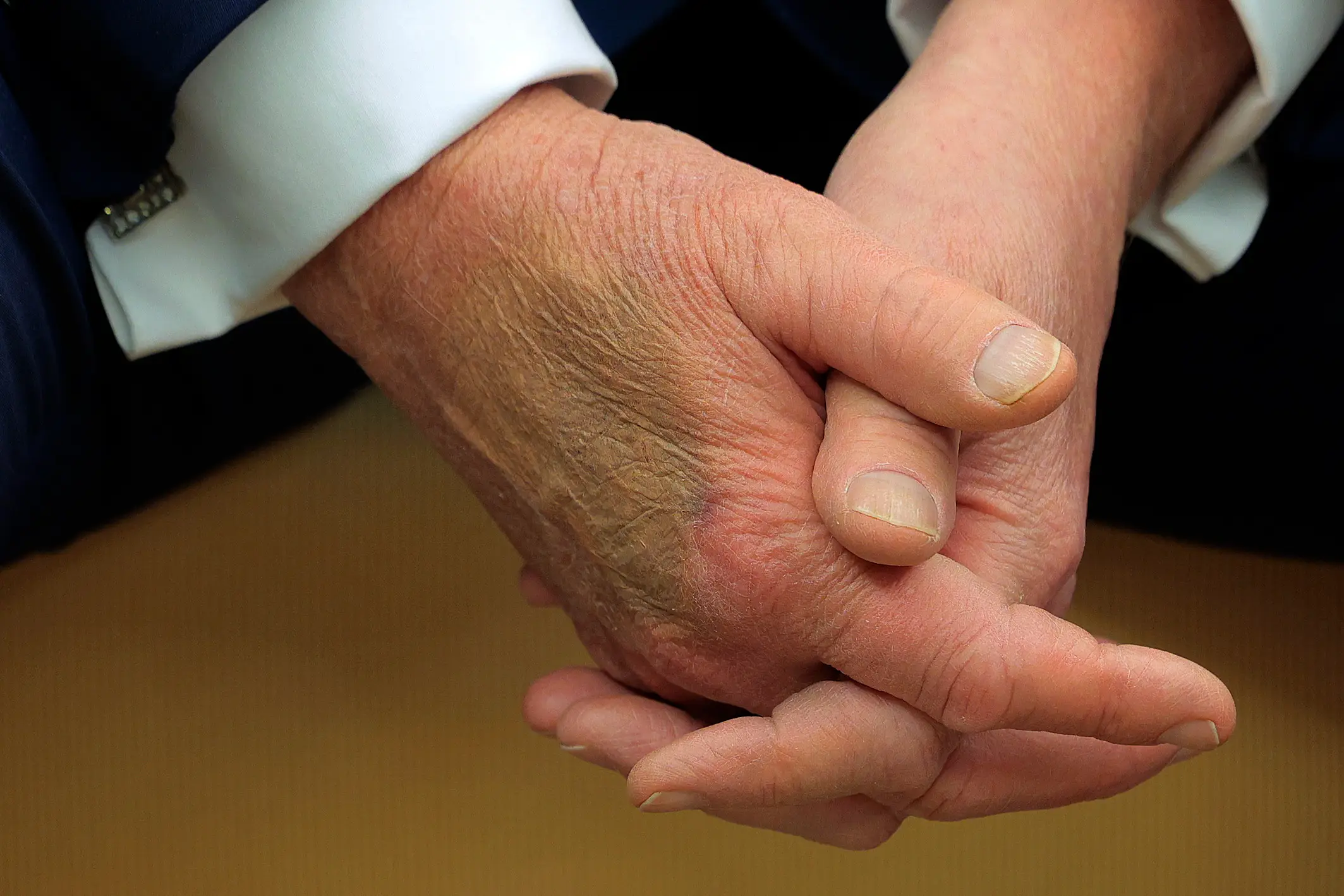 Makeup seen on Trump's hand in February last year (Chip Somodevilla/Getty Images)
