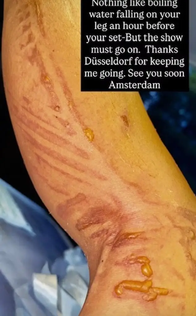 She shared a photo of the burns she suffered right before going on stage. (nicolescherzinger/Instagram)