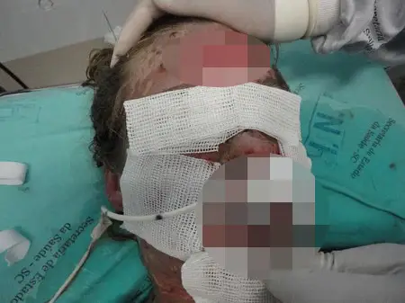 Jaqueline was suffering from the very rare condition of Stevens-Johnson Syndrome. (Jam Press/@jaque_gmack)