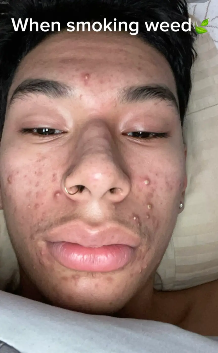 The YouTuber said he used to get multiple whiteheads after smoking cannabis (YouTube/Patrick Merino)