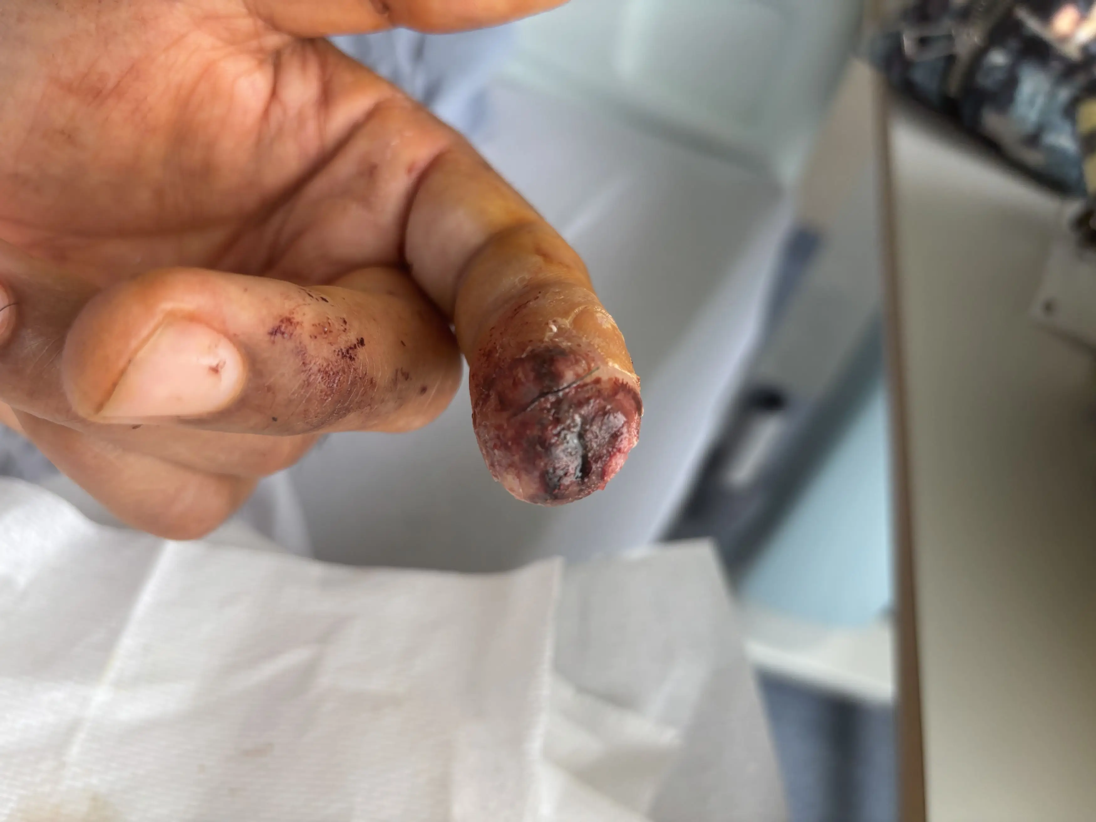 The cat latched onto his left index finger and left him with a grisly infection (Kennedy News and Media)