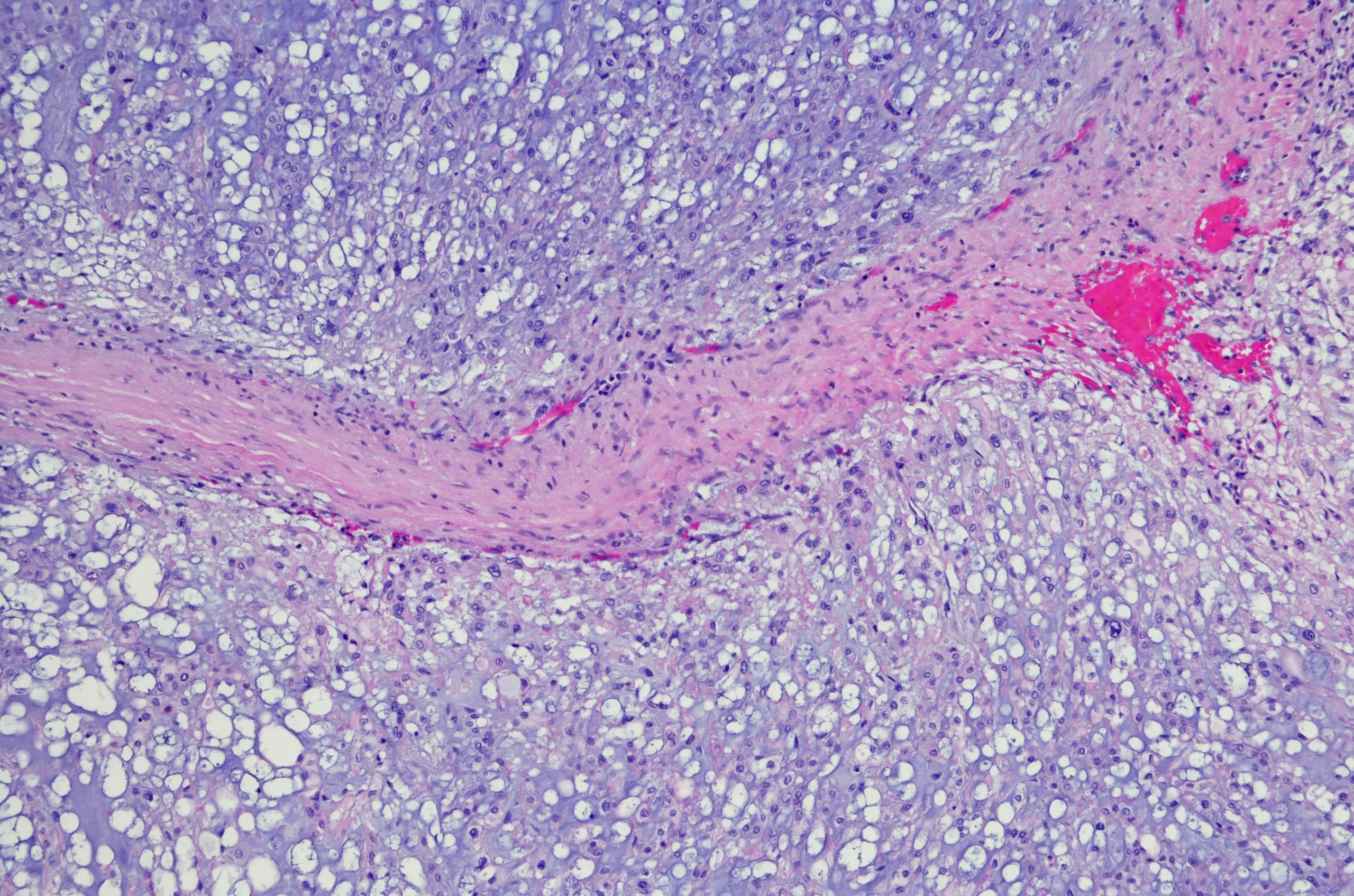 Chordoma is a very rare form of bone cancer (Getty Stock Images)