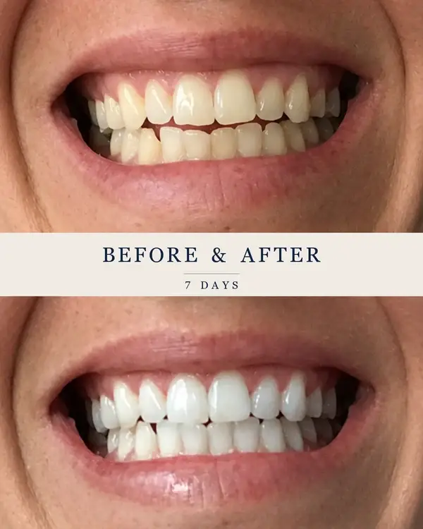 Customers have shared their results online (SmilePro)