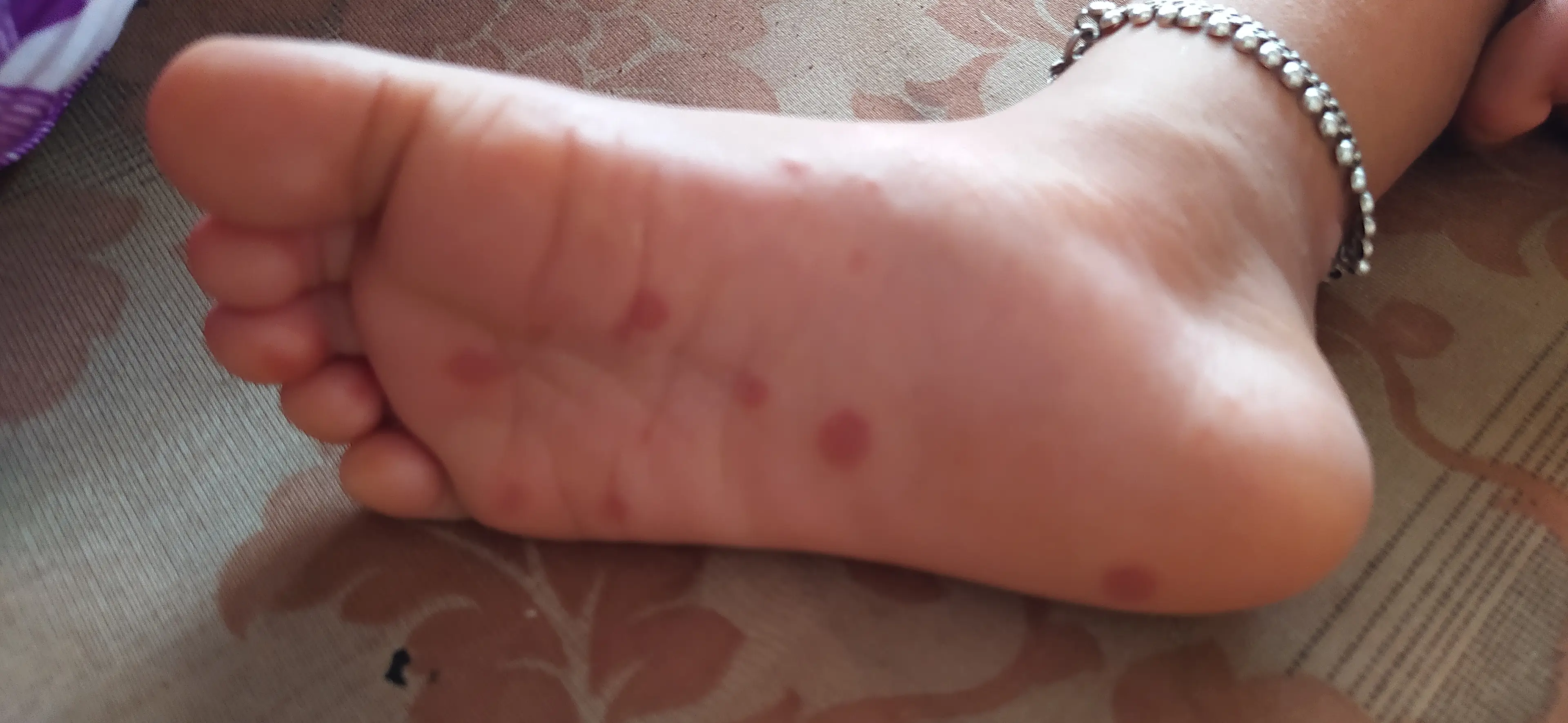 Hand, foot, and mouth disease.