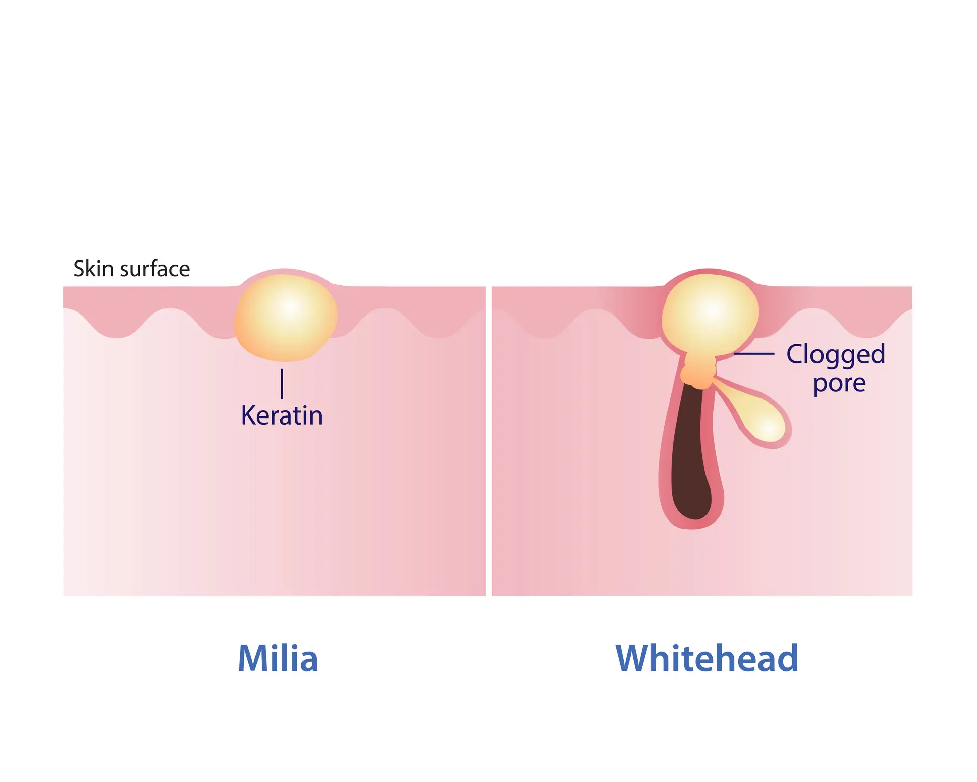Unlike spots and blackheads, milia are not caused by clogged pores, meaning the extraction is different  (Getty Stock Images)