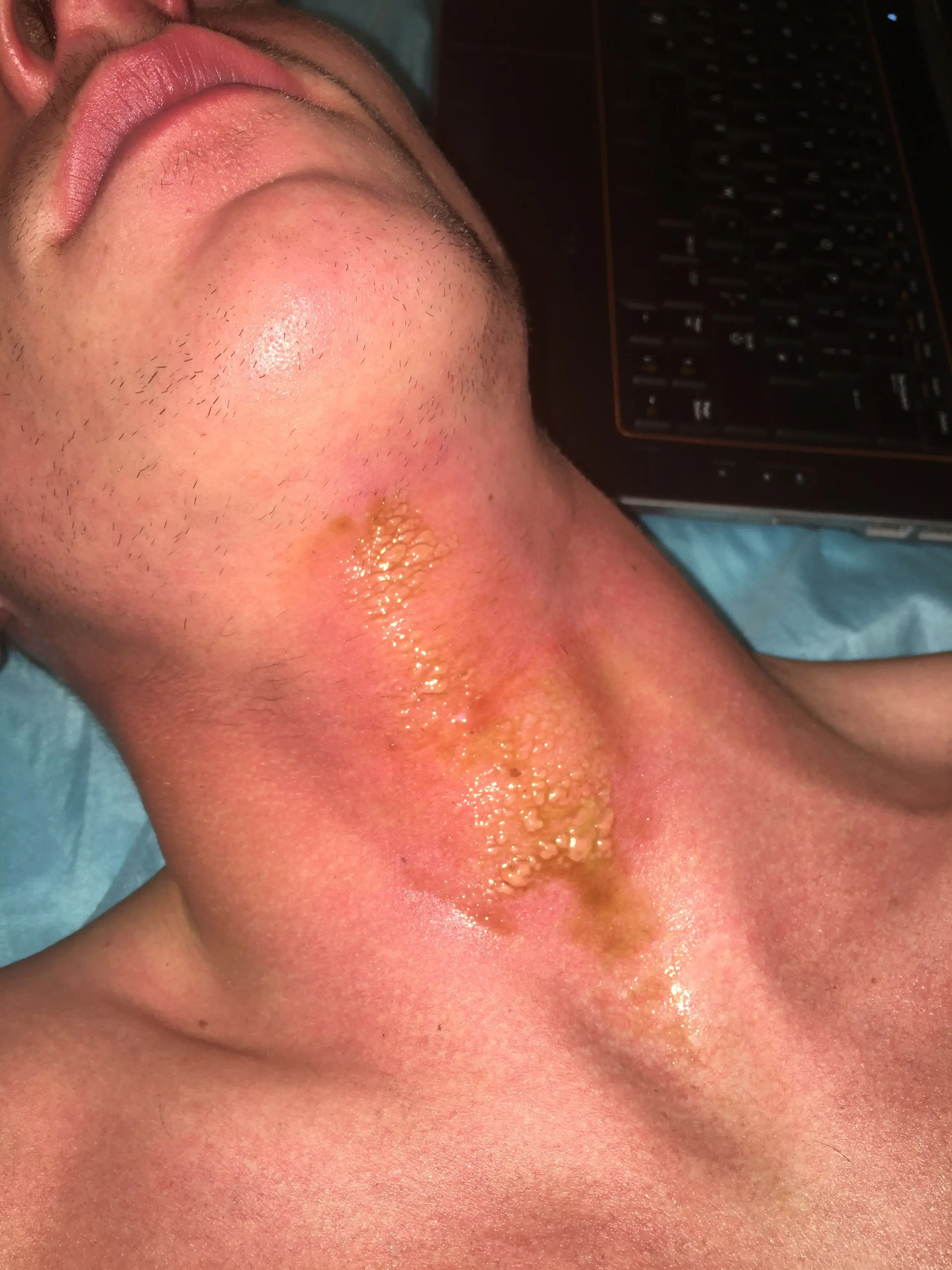 The 27-year-old believes his gold necklace 'reflected and magnified the sun' right onto his neck (Kennedy News and Media)