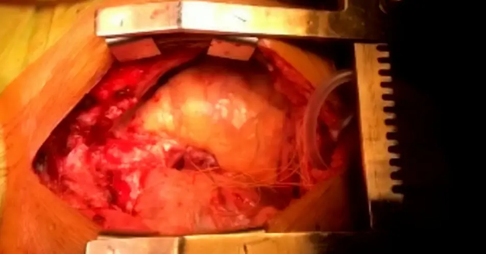 Suresh has both a male and female heart beating in his chest.