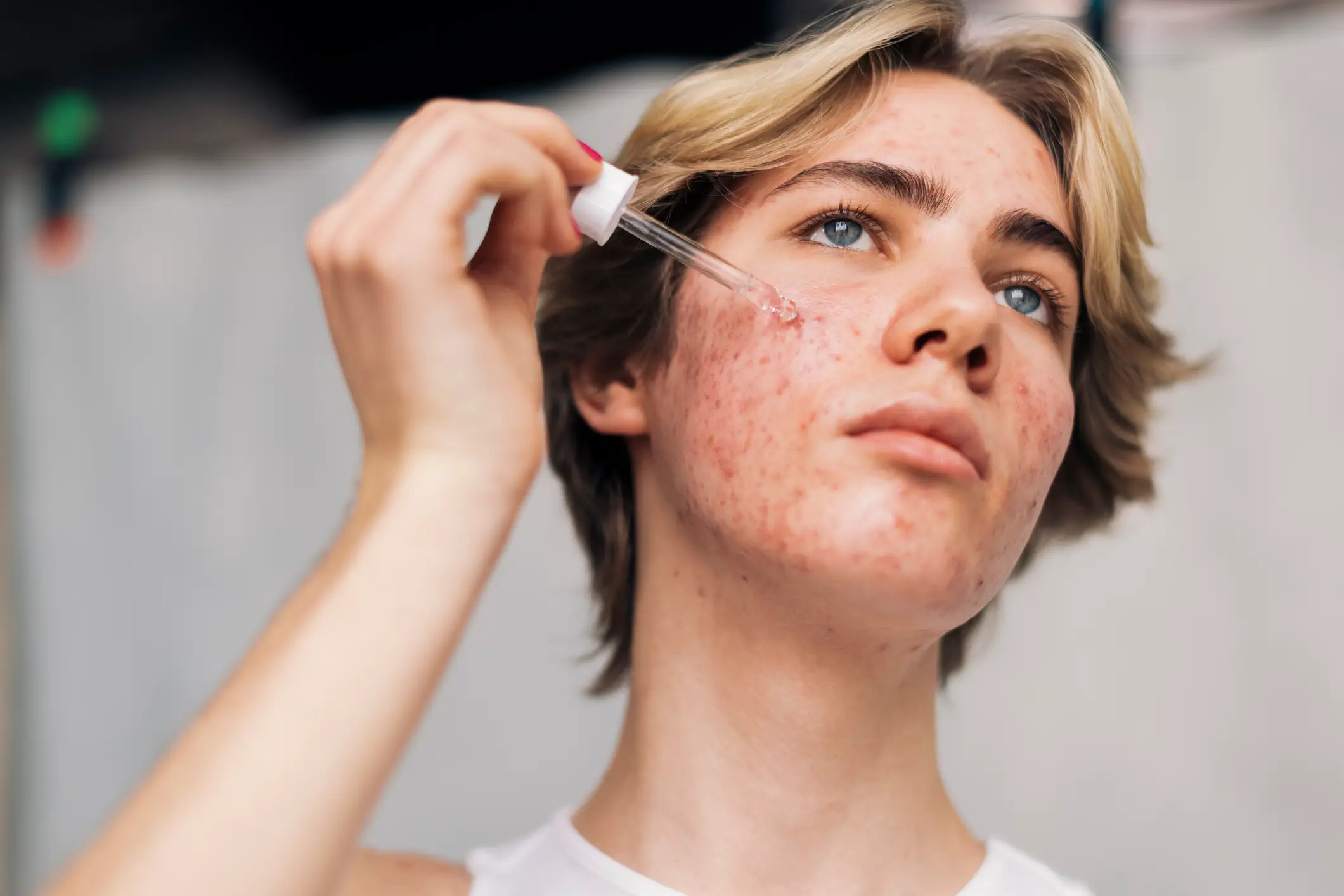 Its bad news of us adults, as acne doesn't end with our teenage (Getty Stock Images)