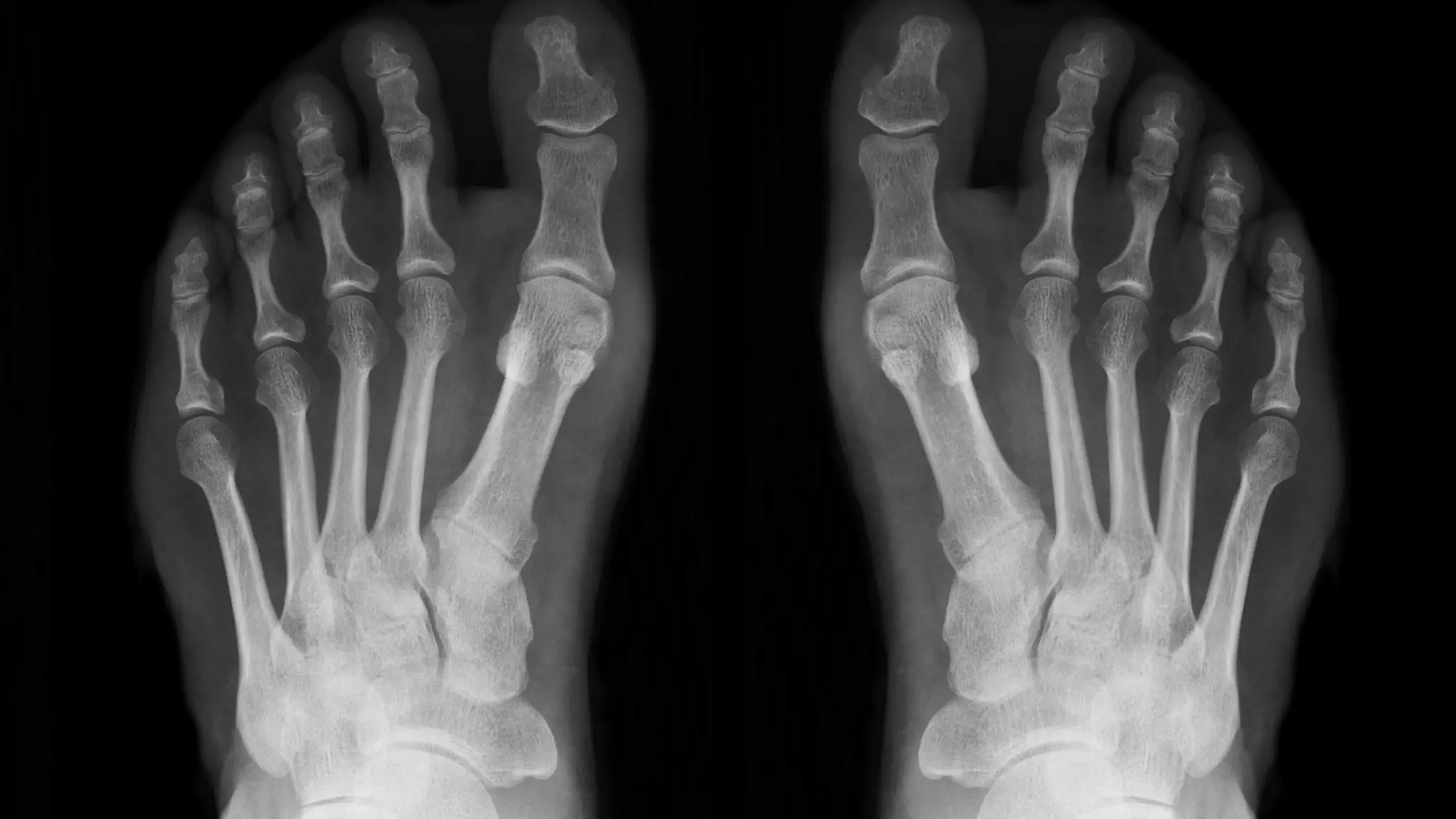 Weird theory explains why you've never broken a bone