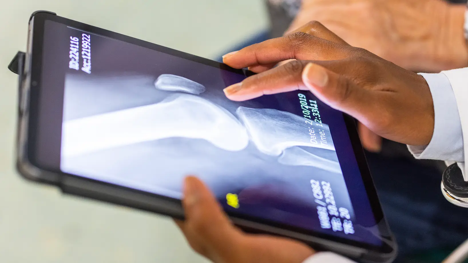 Doctor answers strange theory about people who’ve never broken a bone