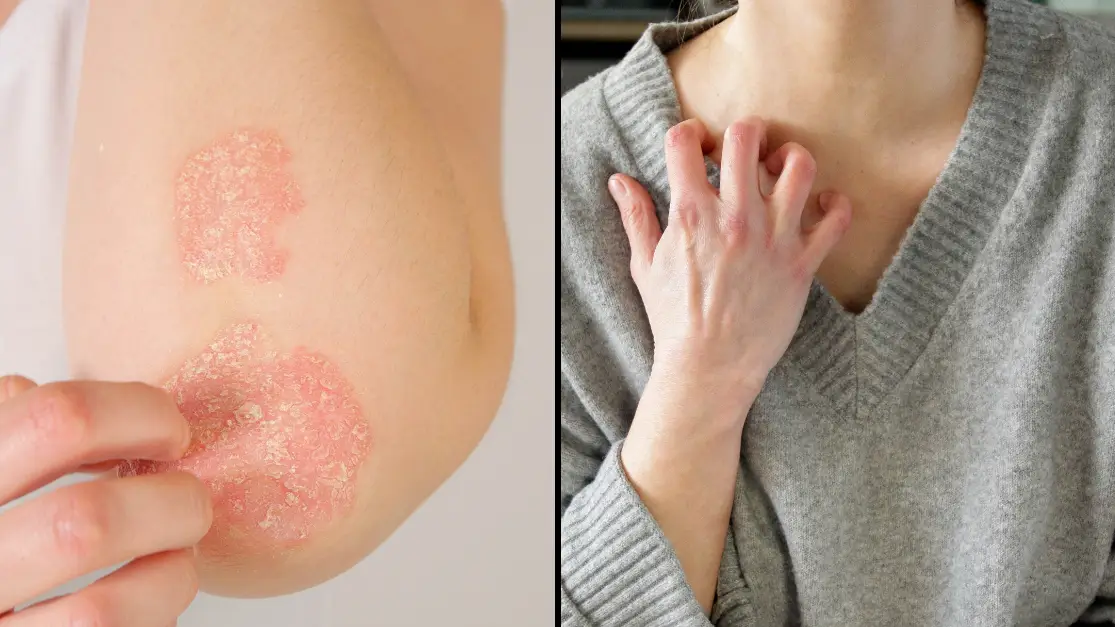 Doctor warns ‘invisible disease’ that half a million Brits have may be caused by scaly skin condition