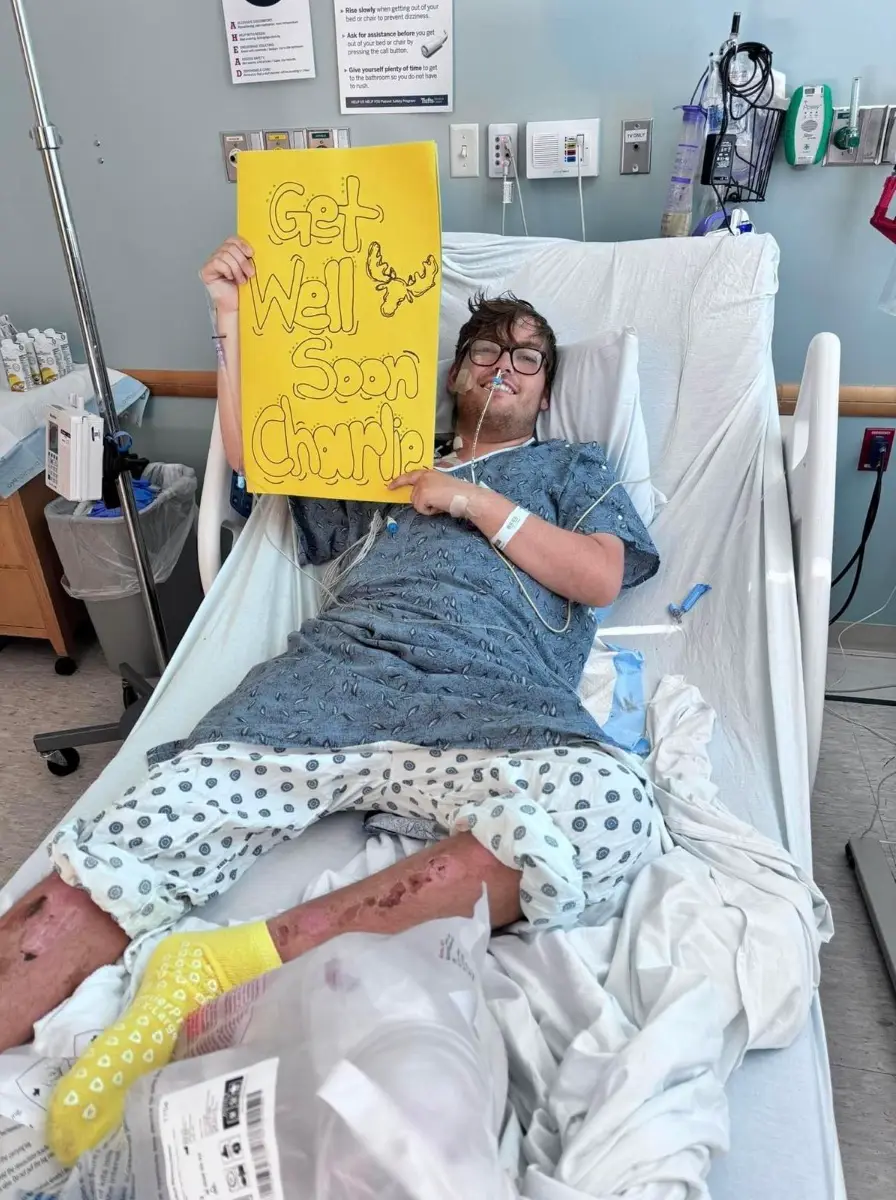 The 20-year-old student only found out about his hidden condition after suffering from second degree sunburn (PA Real Life)