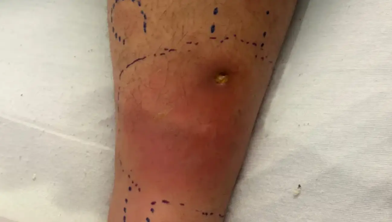 The infection can be deadly (GoFundMe)