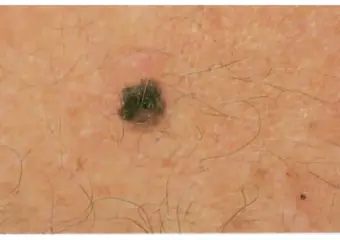 E is for Evolving (Skin Cancer Foundation) 