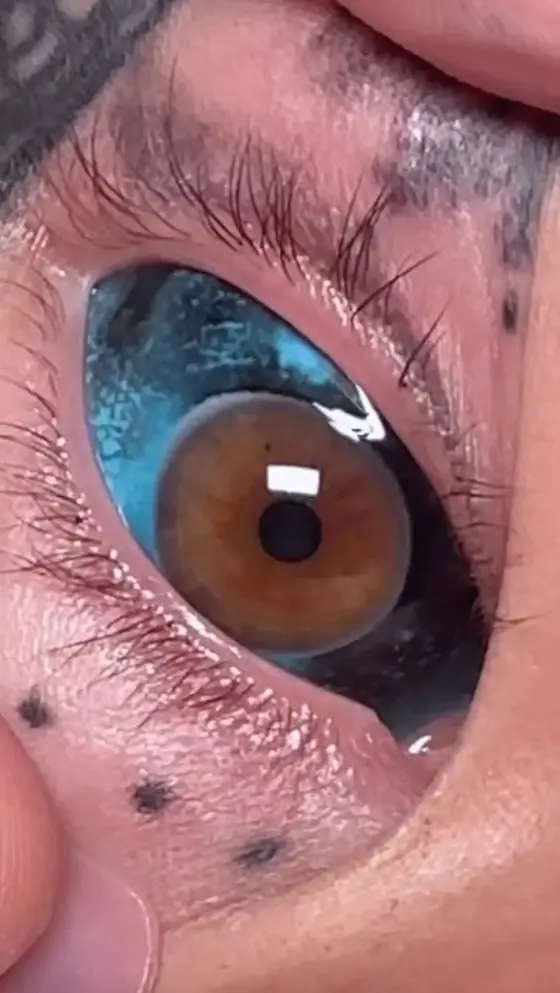 Her eyes are now black and blue after the procedure, which she said didn't hurt this time. (Jam Press)