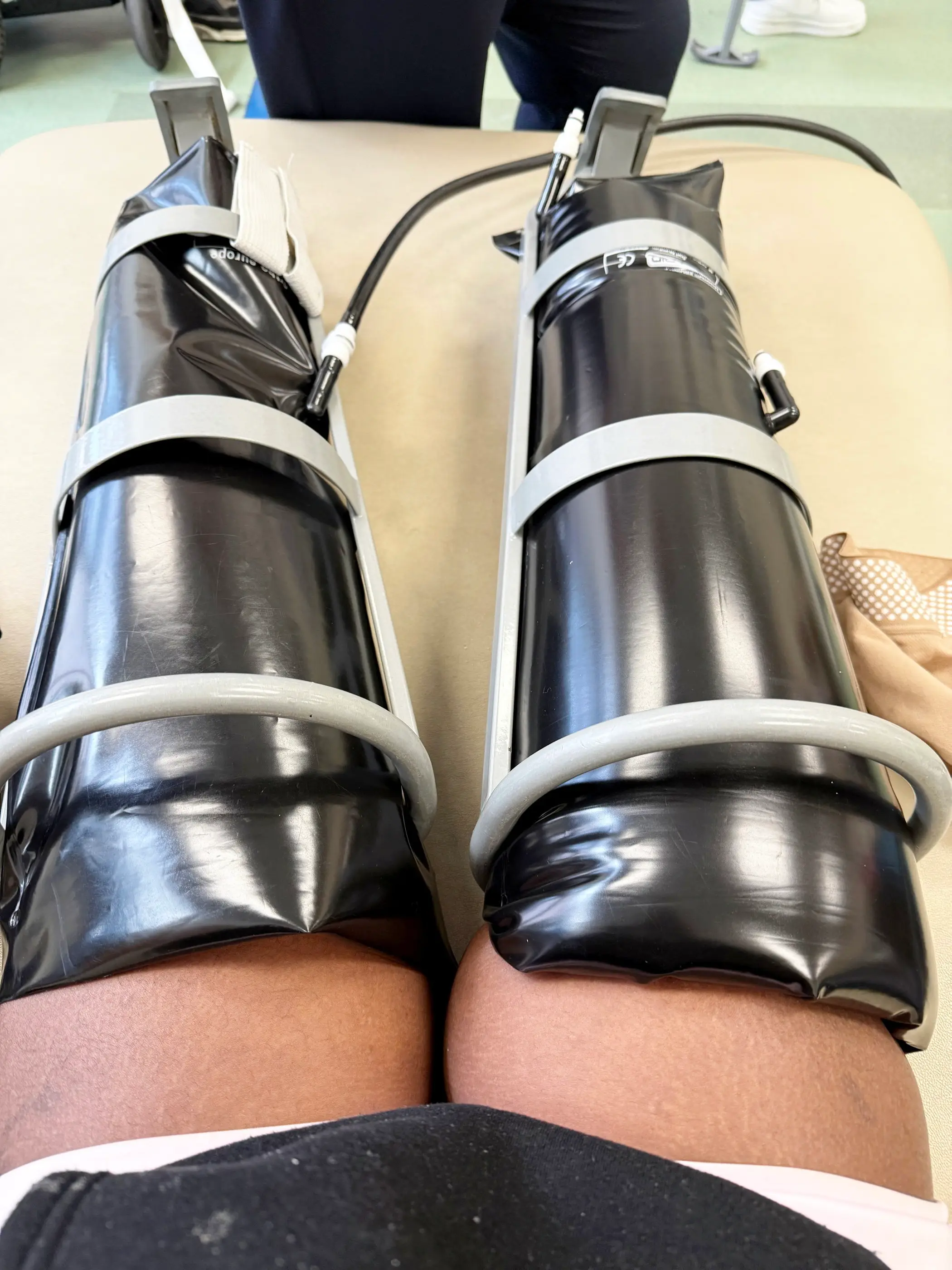 She lost both of her lower legs (SWNS)