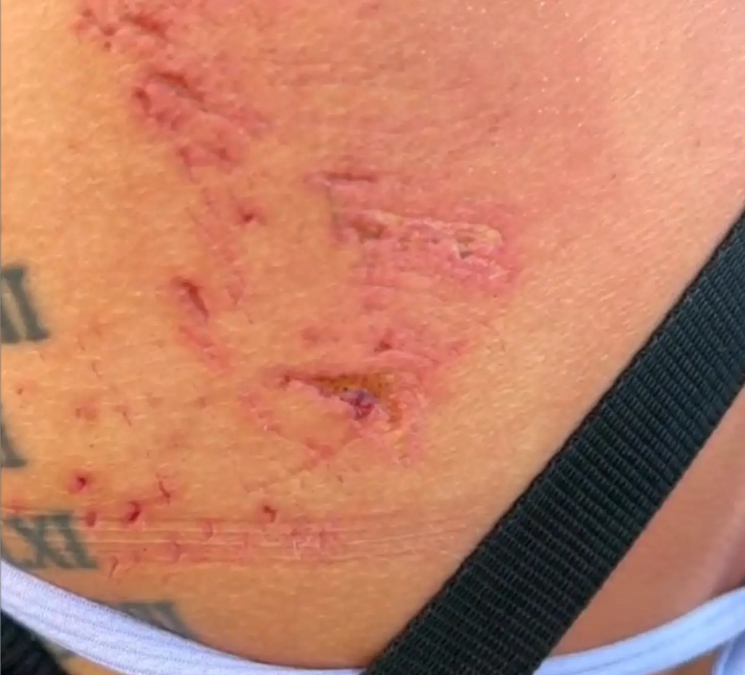 The bite covered some of her upper back and shoulder.