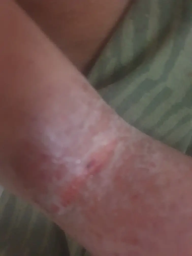 She suffers severely. (MEN Media)