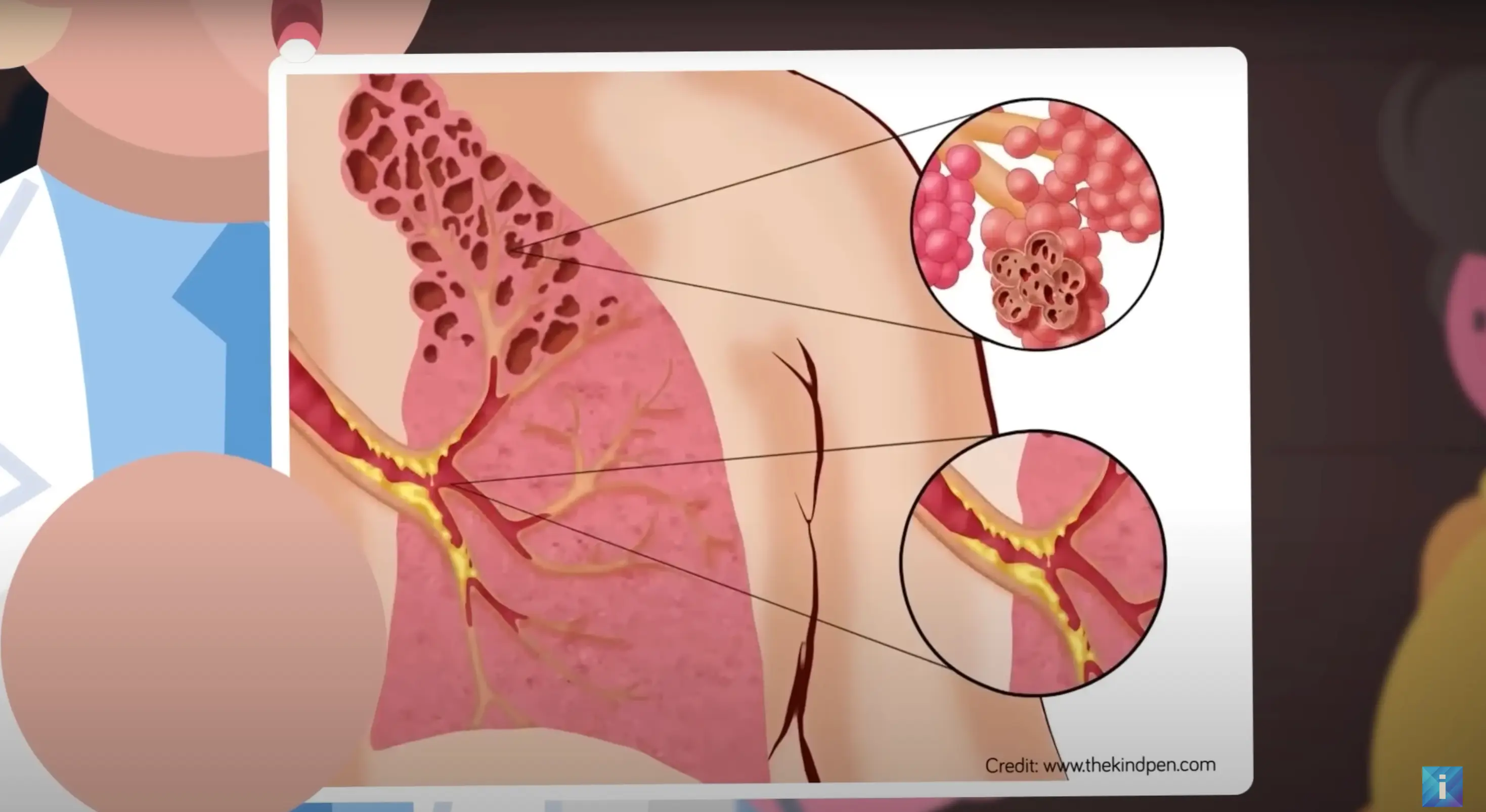 Popcorn lung looks disgusting (Youtube/The Infographics Show)