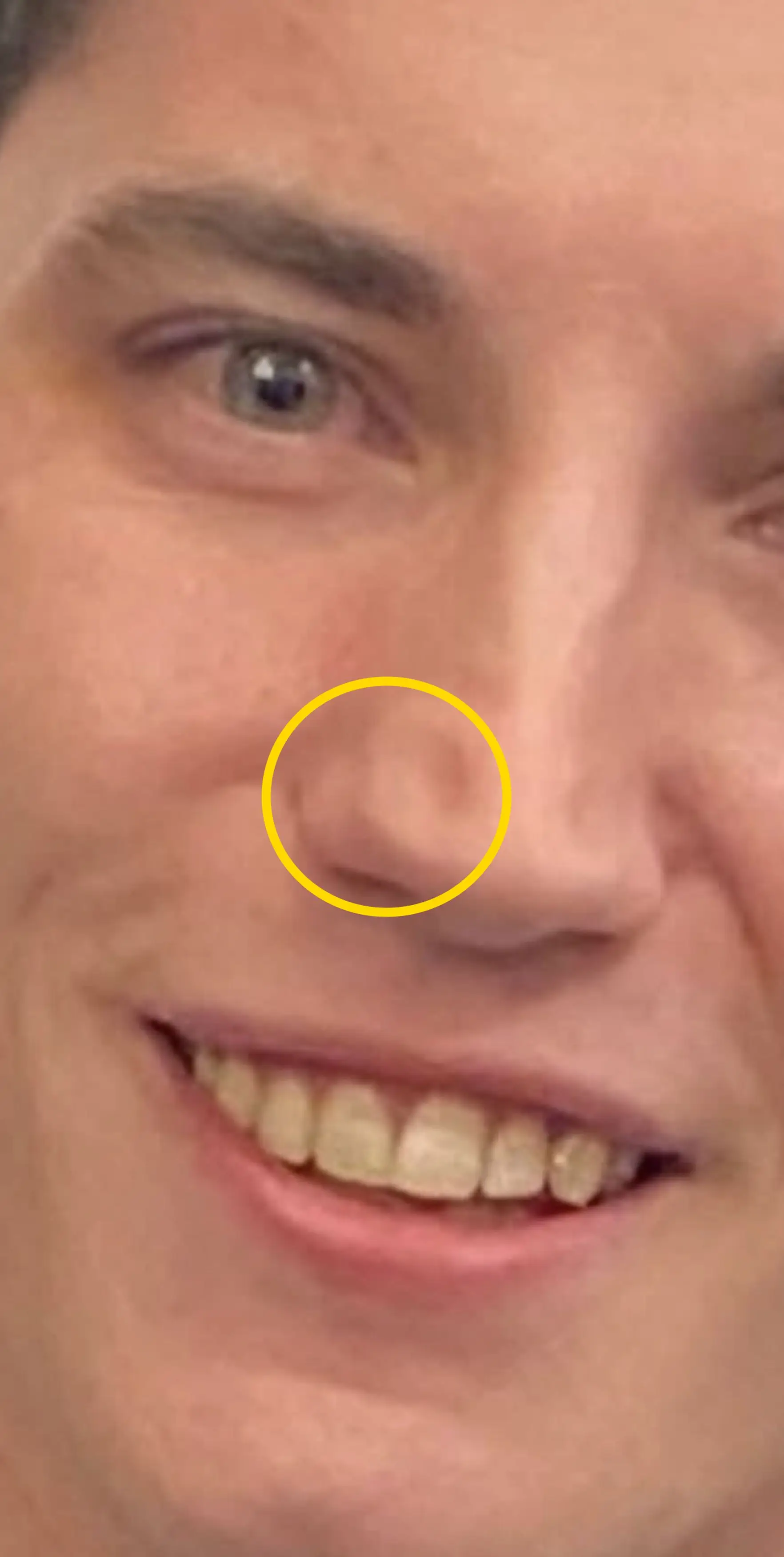 Coke nose is a term for the physical damage caused to the nasal passages by snorting cocaine over time (Kennedy News and Media)