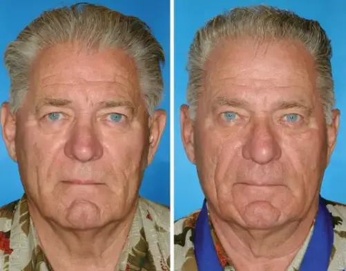 Both twins are smokers. The twin on the right smoked 14 years longer than his brother (American Society of Plastic Surgeons)