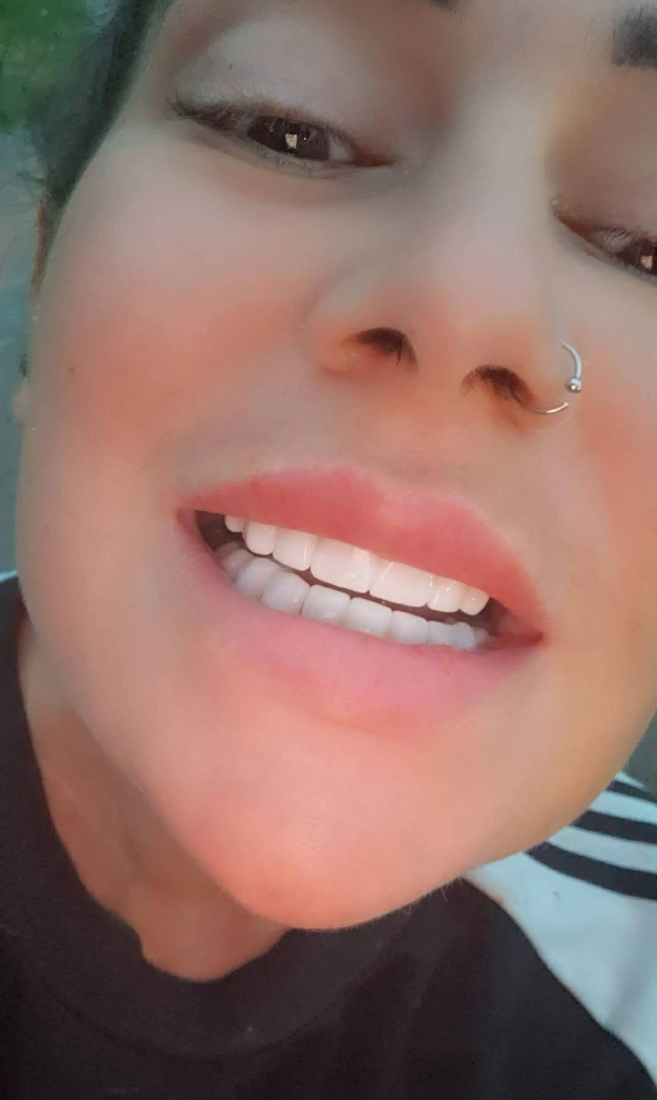 Jackie is now waiting for a permanent set of false teeth, but the ordeal has taken a toll on her mental health (Kennedy News and Media)