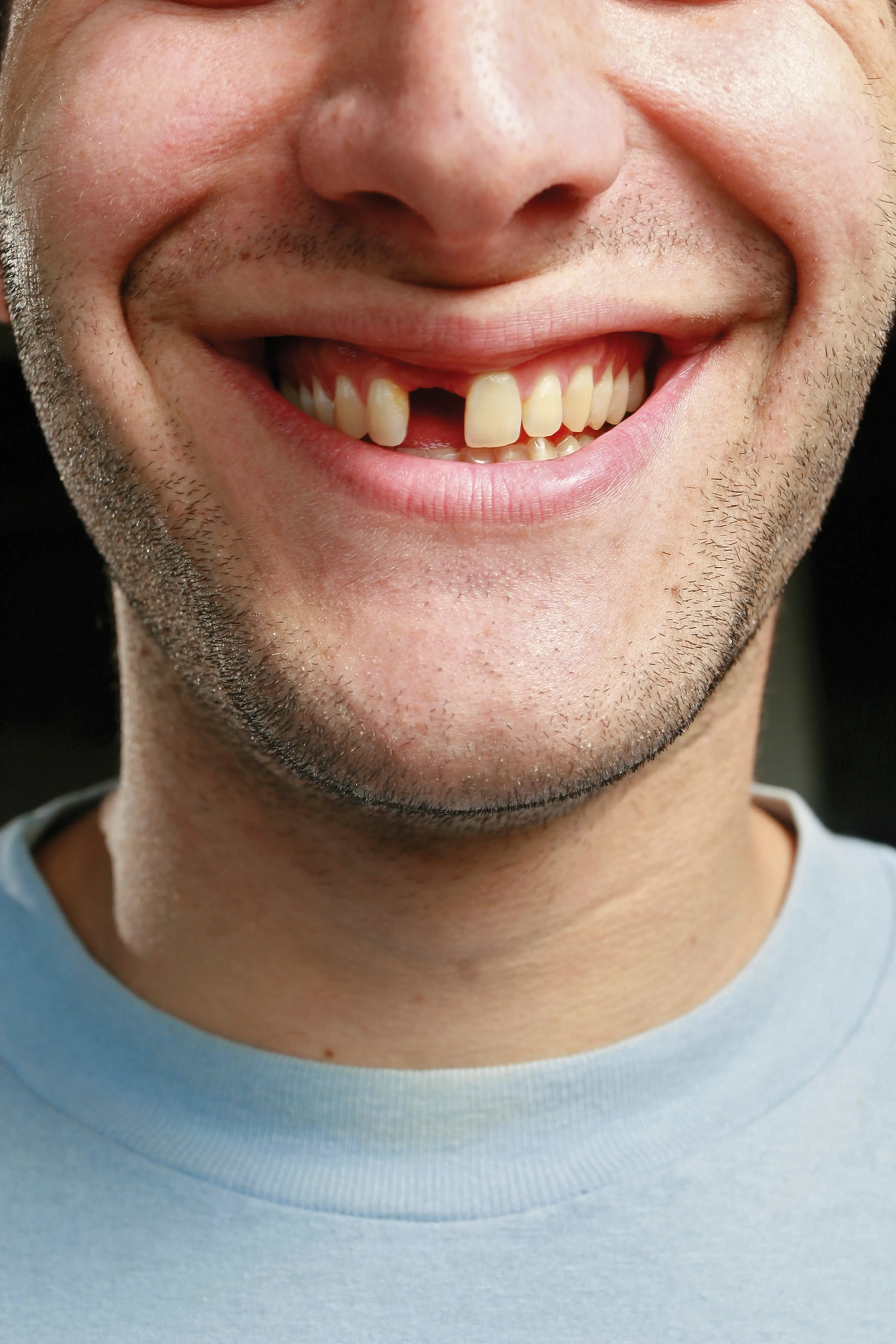 One missing tooth isn't enough to ring alarm bells, usually (Getty Stock Images)