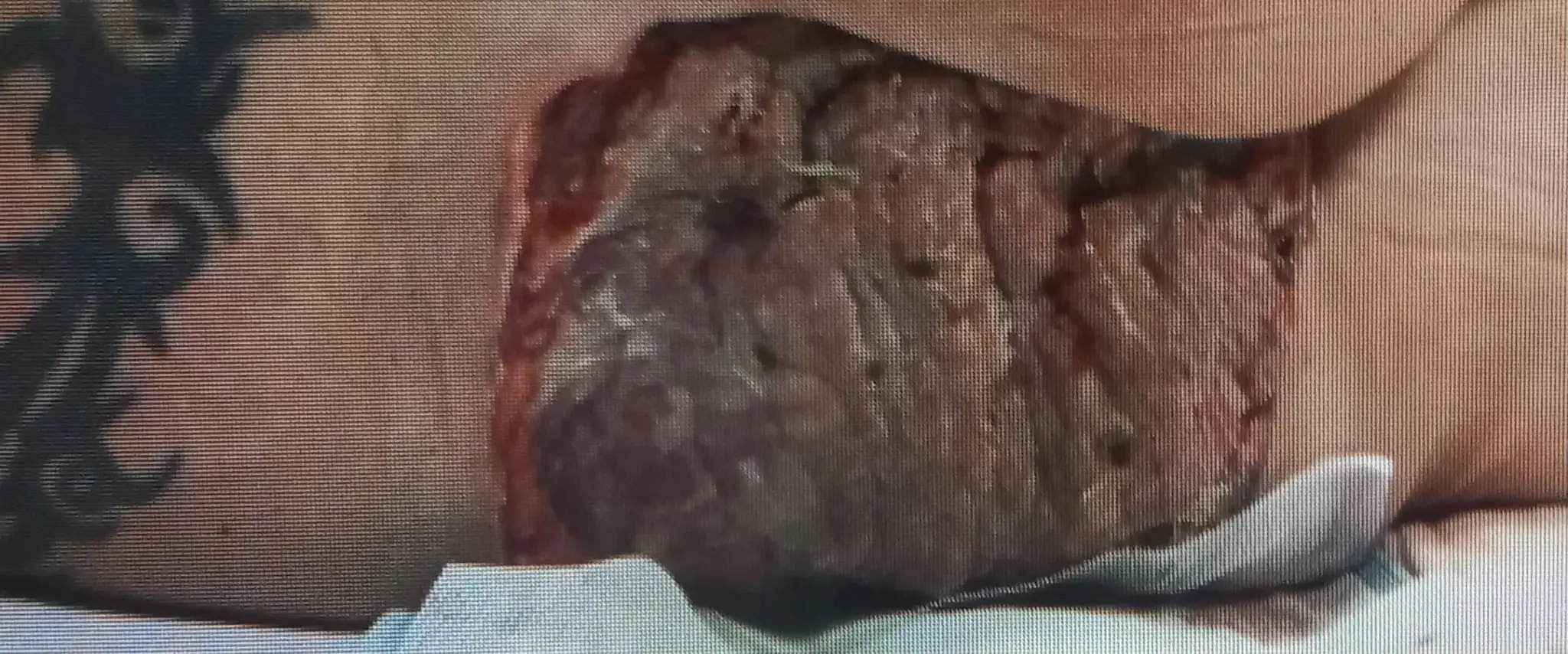 Simon was forced to spend three months in hospital after a flesh-eating bug attacked his bum (SWNS)