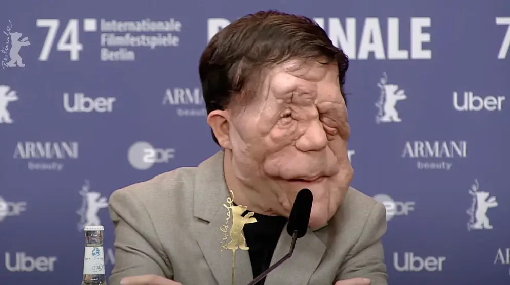 Adam Pearson has neurofibromatosis.