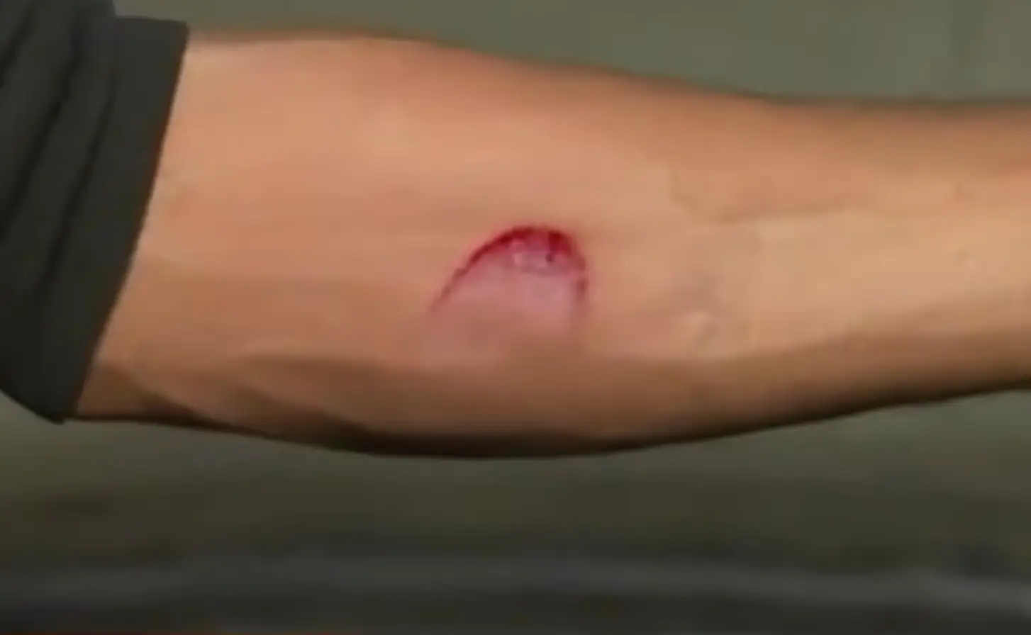 Phillips revealed the aftermath of the bullet grazing the skin on his arm (ITV)