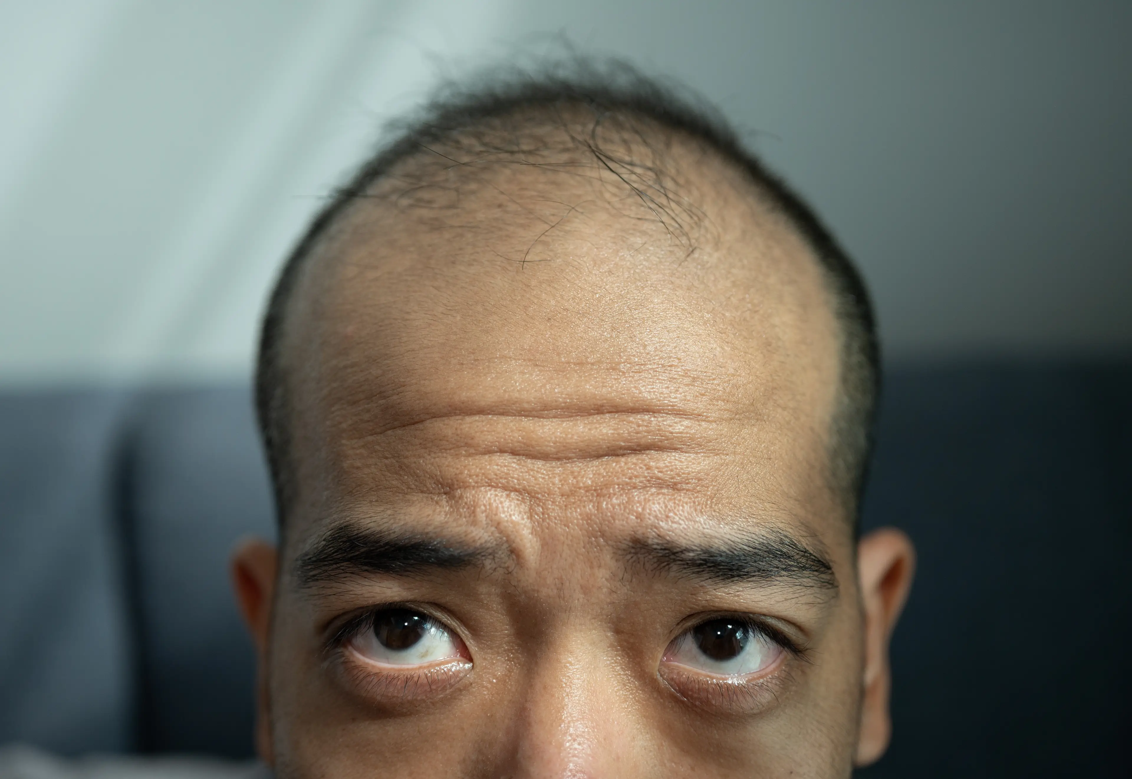 Stress can lead to hair loss, new research might help put a stop to the balding. (Getty Stock Image)