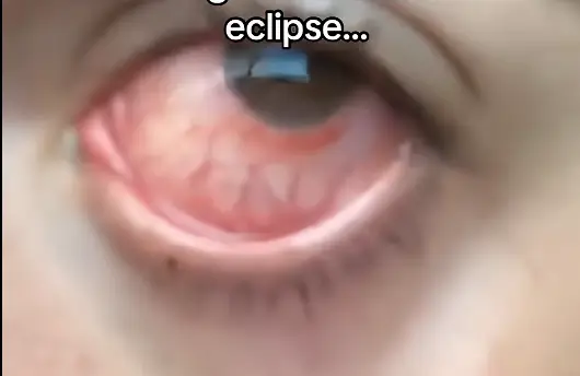 His eye looks very painful (TikTok/DannyBoy)