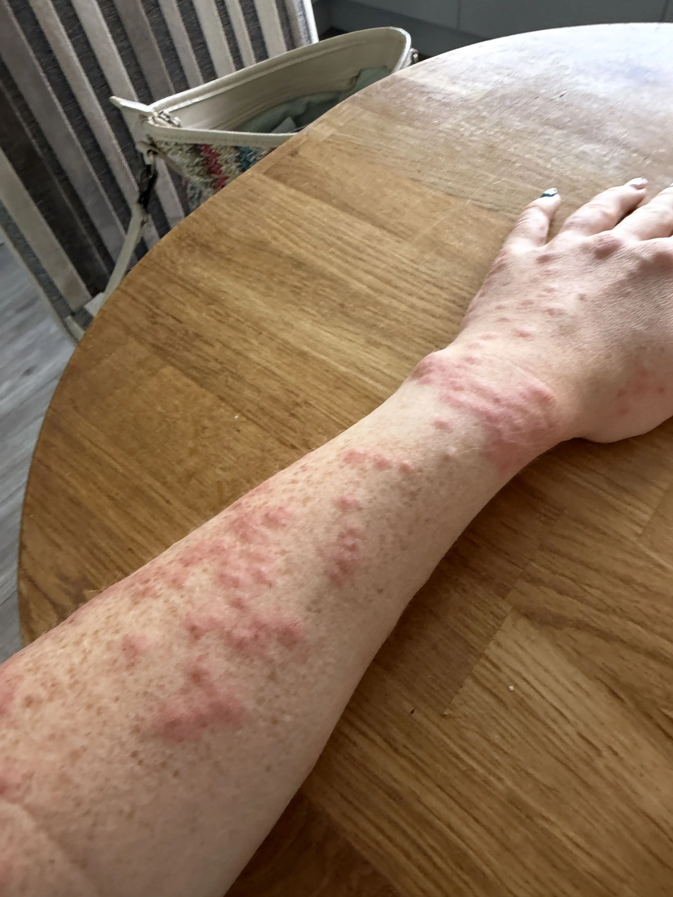Hannah's arm was left itchy and red (Kennedy News and Media)