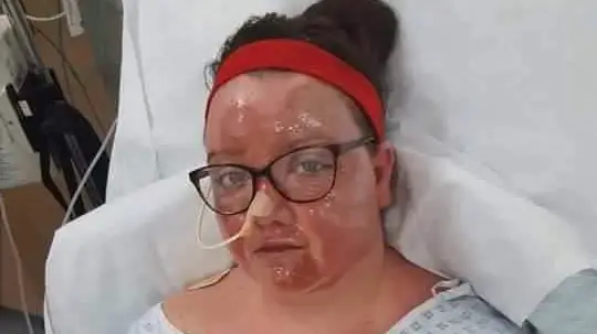 Brave mum recalls surviving 33,000 volt shock that burnt her skin off in hot air balloon disaster