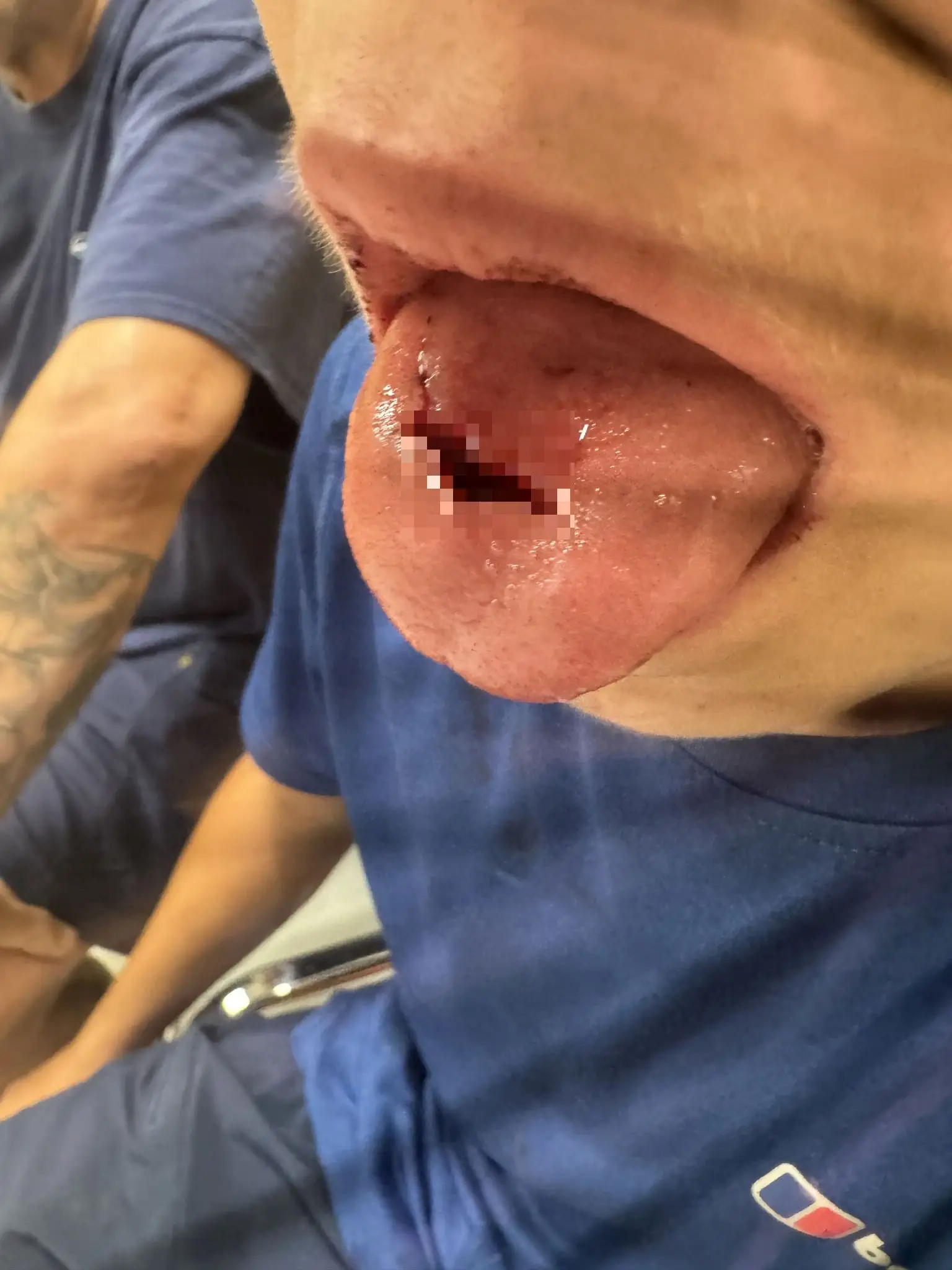 The teenager had nearly severed his tongue after falling down and hitting his chin (Kennedy News and Media)