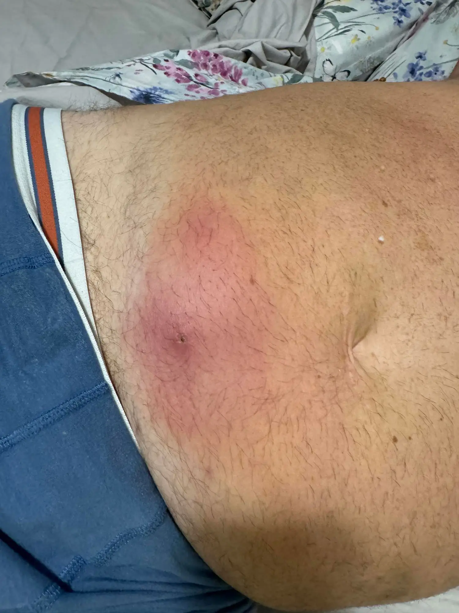 The bite worsened over a few days (Jam Press)