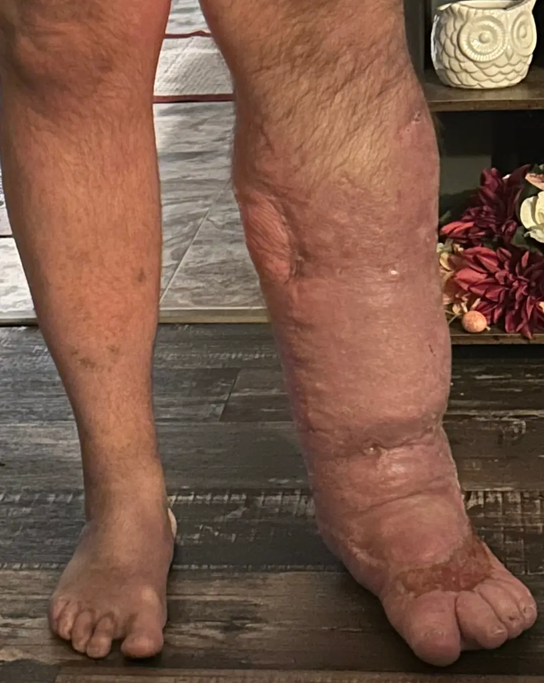 His leg swelled to eight times its size (GoFundMe)