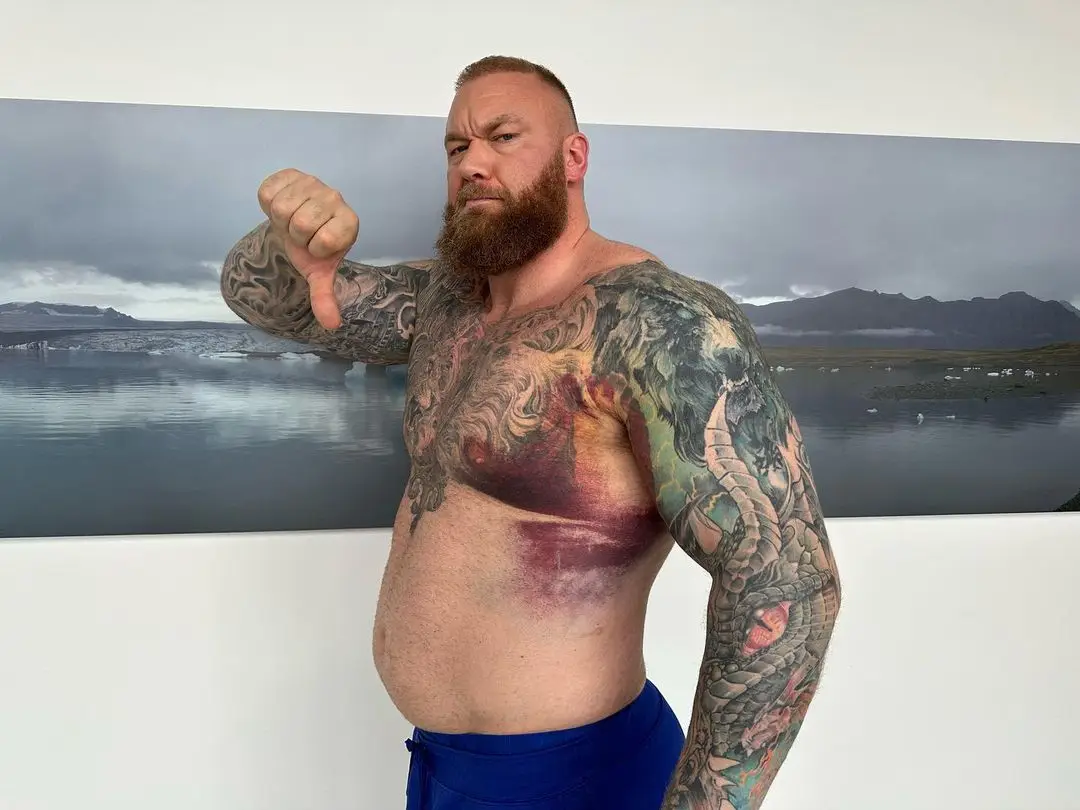 The hefty bruise covers the top of his armpit all the way down to his lower ribcage.