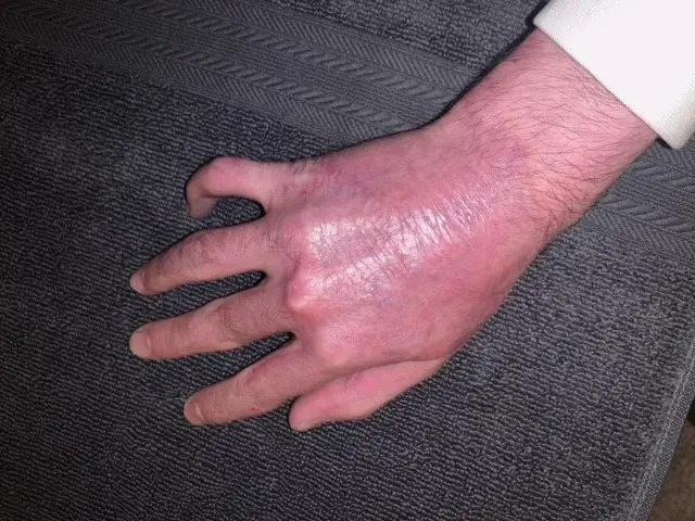 He has since undergone skin grafts and will need further surgery (SWNS)