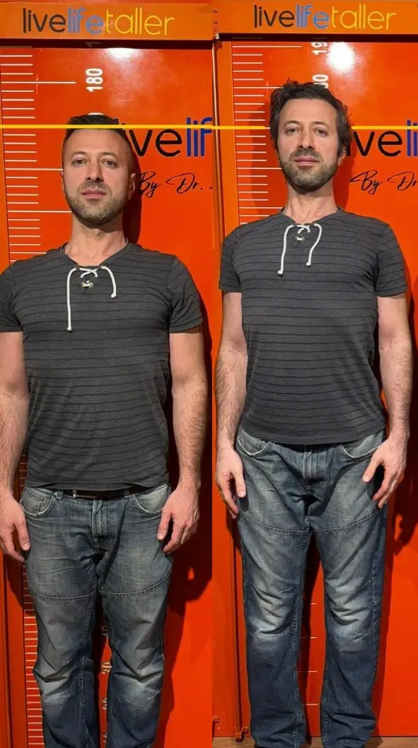 The surgery to become 3.7 inches taller cost him £36k (PA Real Life)