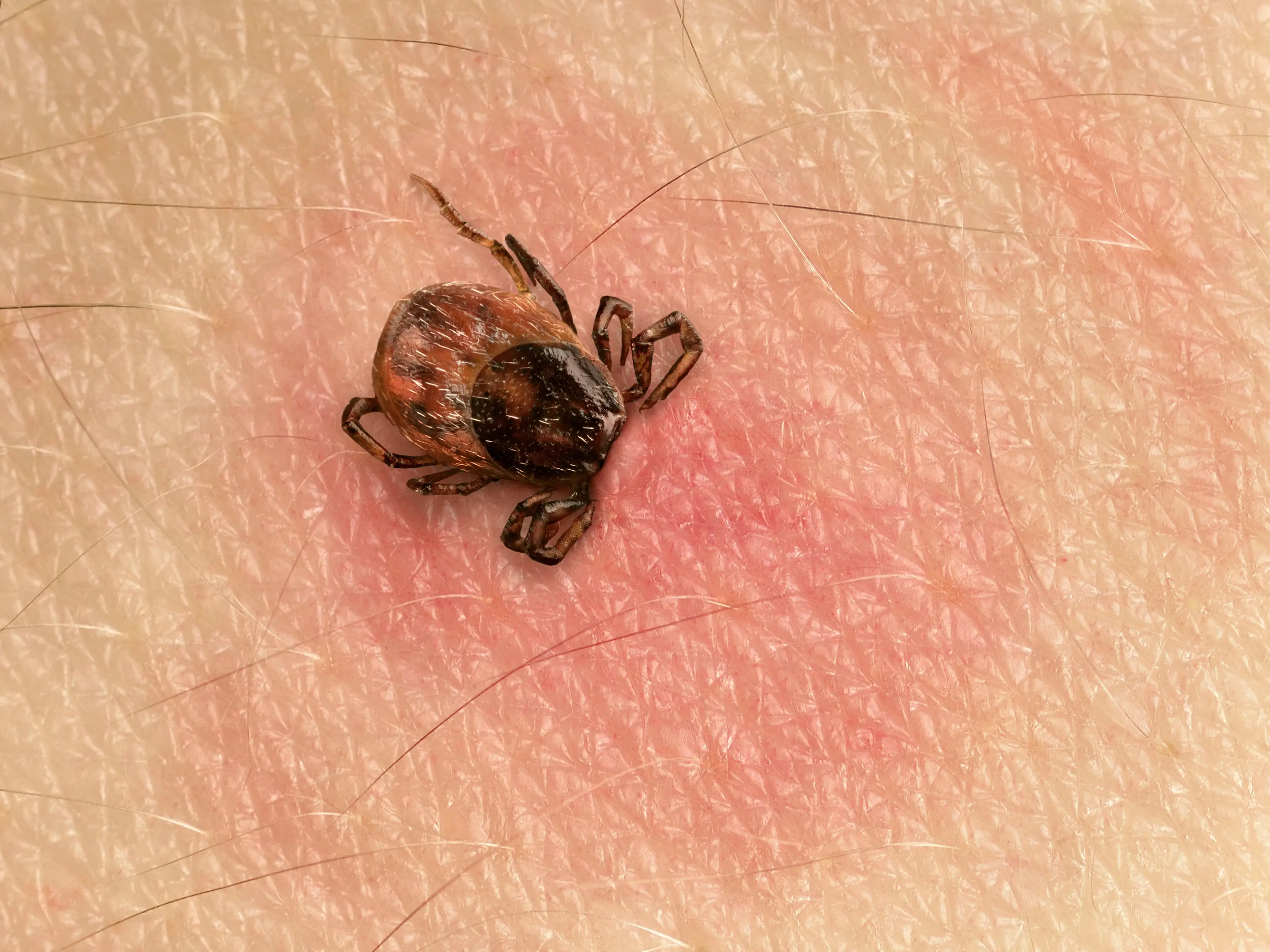 It is suspected that tick bites he suffered as a two-year-old may have given him a mammalian meat allergy (Getty Stock Image)
