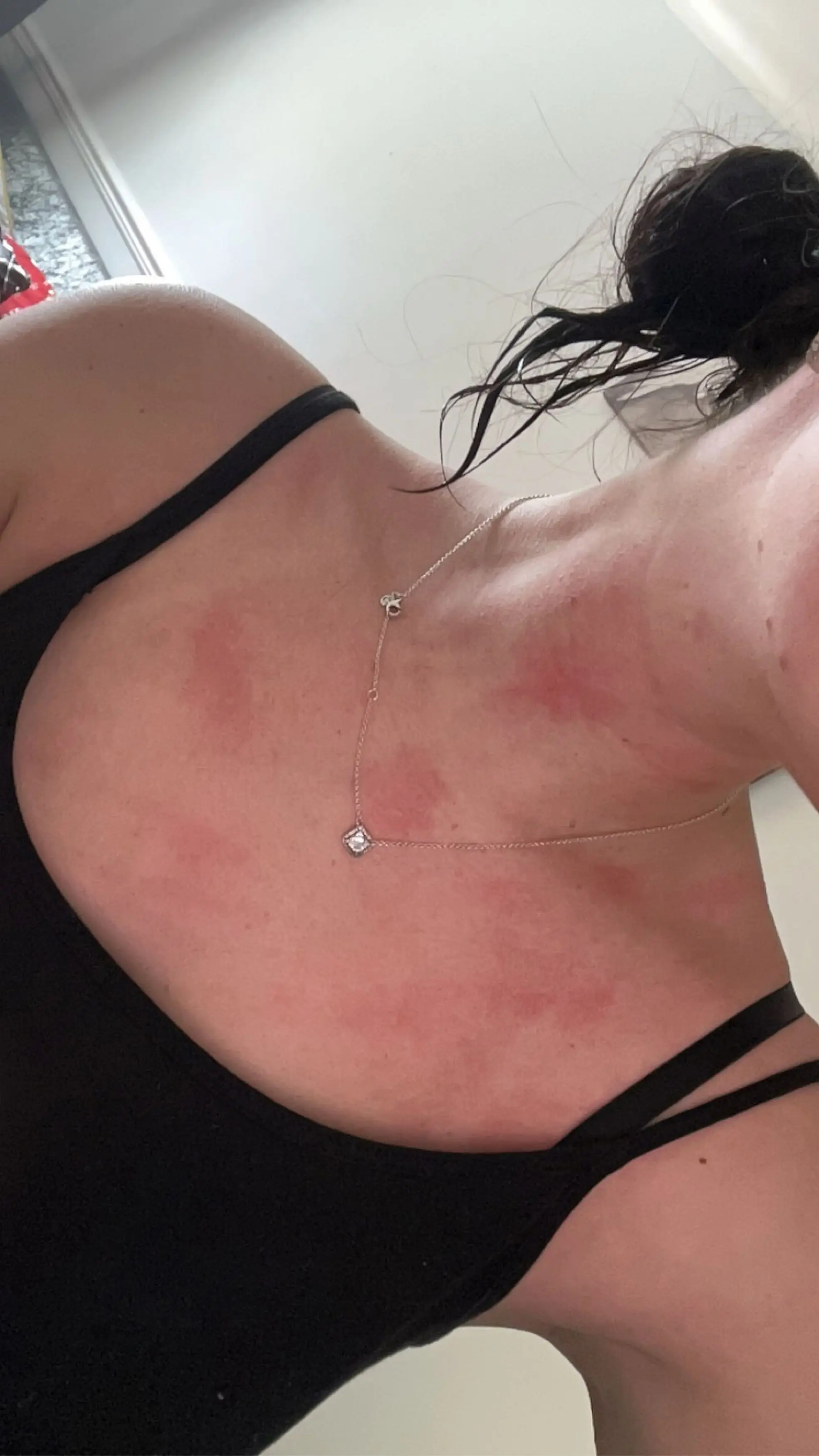 She breaks into painful rashes upon contact with water or sweat (Kennedy News and Media)