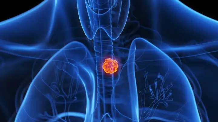 Acid reflux can turn cells cancerous if left for too long (Getty Stock Image)